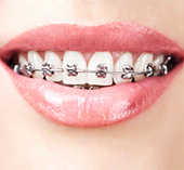 braces - la plaza dental